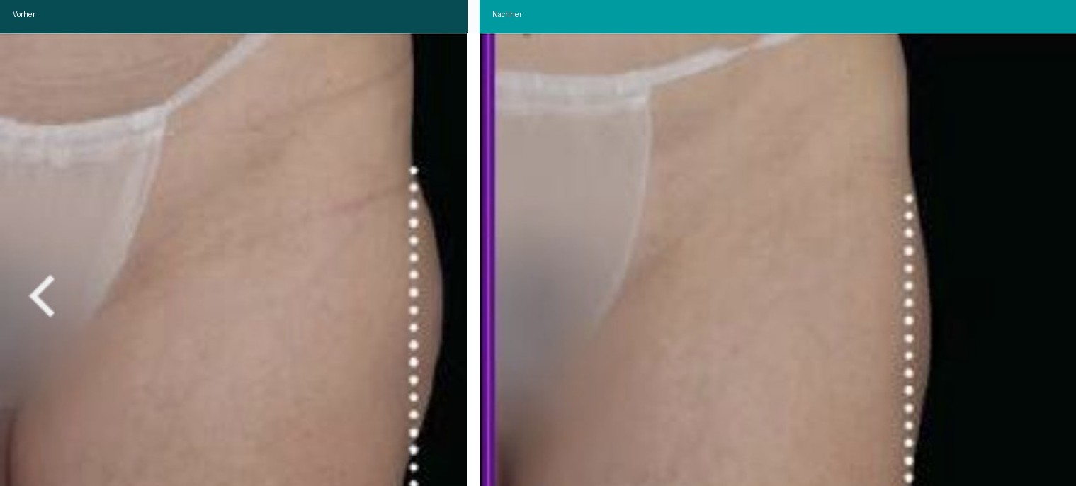 Cellulite / T-Shape Vorher Nachher Hanau