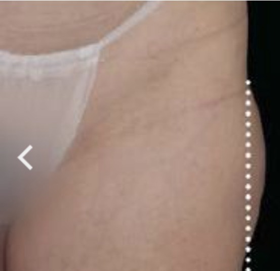 Vorher Cellulite T-Shape Hanau