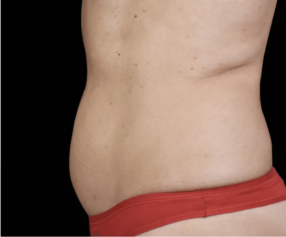 Nachher Cellulite T-Shape Hanau