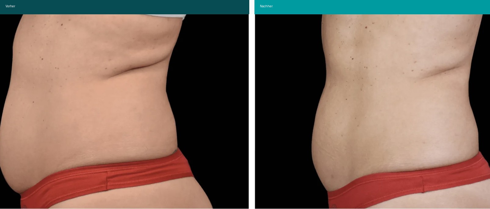 Cellulite / T-Shape Vorher Nachher Hanau