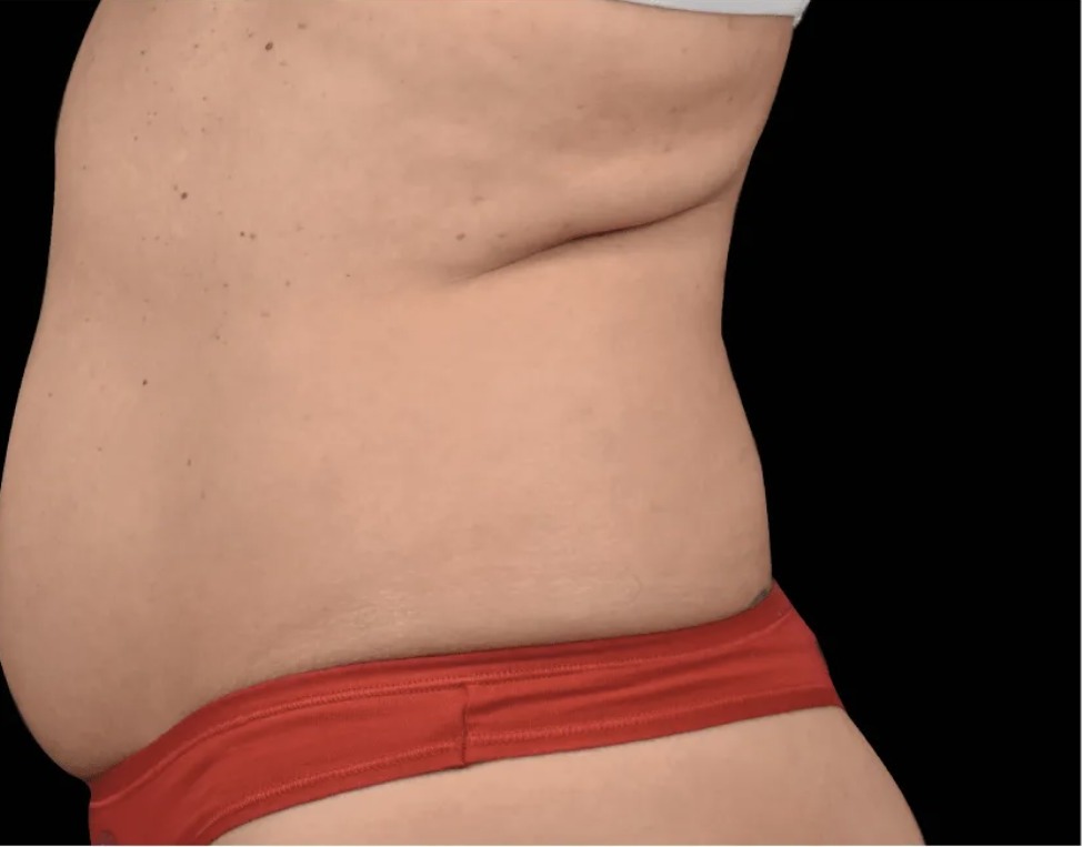 Vorher Cellulite T-Shape Hanau