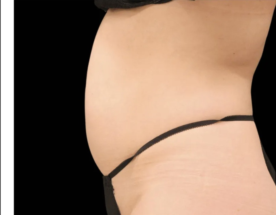 Nachher Cellulite T-Shape Hanau