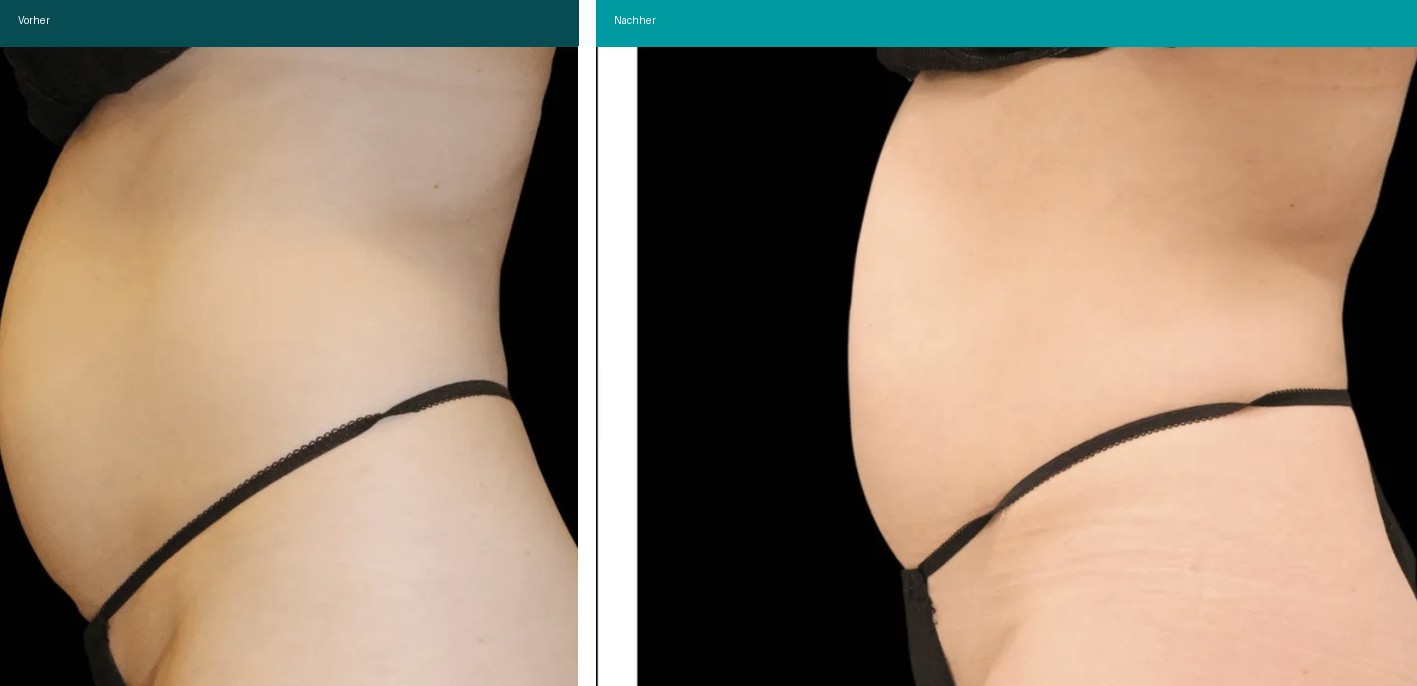 Cellulite / T-Shape Vorher Nachher Hanau