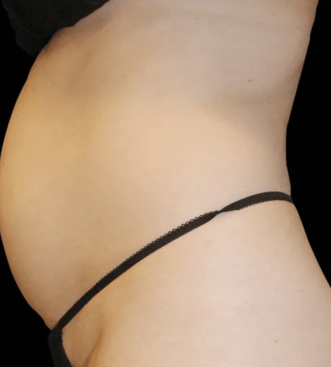 Vorher Cellulite T-Shape Hanau