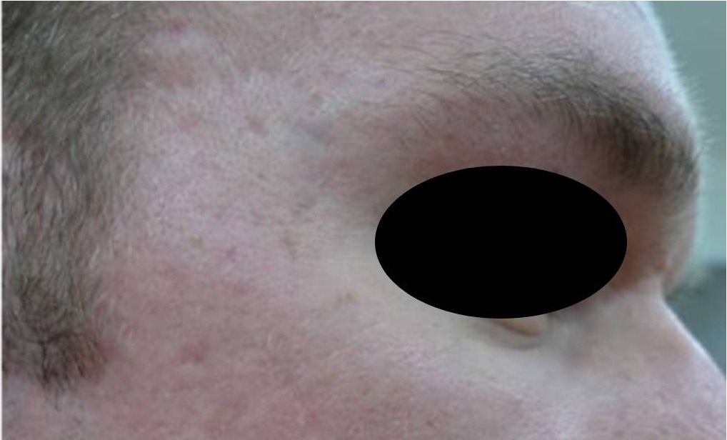 Nachher CO2 Laser Hanau