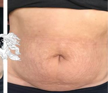 Nachher Striae Behandlung mit dermatologischem Konzept Hanau