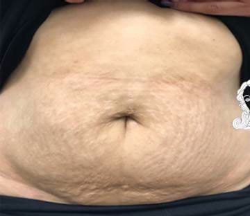 Vorher Striae Behandlung mit dermatologischem Konzept Hanau