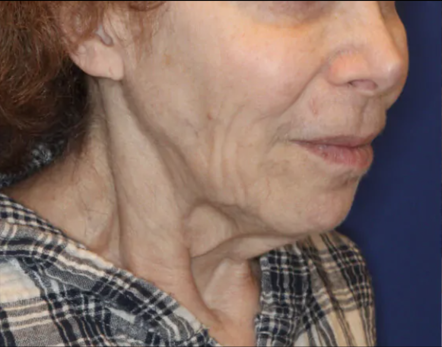 Vor Frax 1550 Behandlung seitliches Gesicht