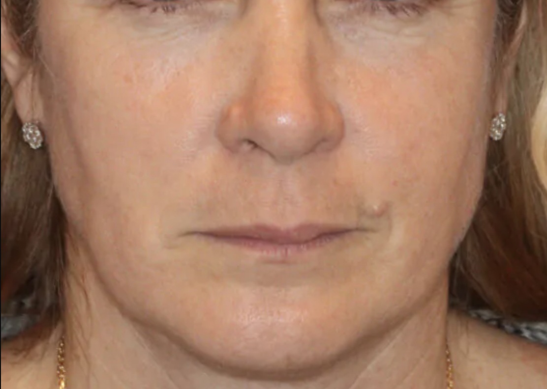 Vor Frax 1550 Behandlung der Gesichtskontur frontal