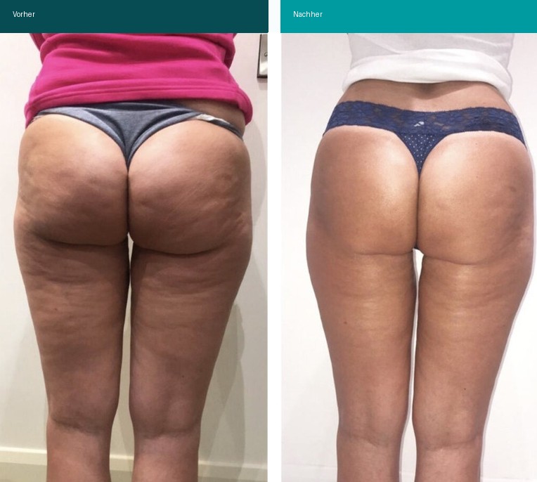 Aesthetische Dermatologie Vorher Nachher Hanau
