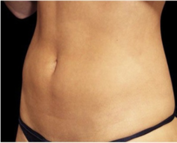 Nachher Aesthetische Dermatologie Hanau