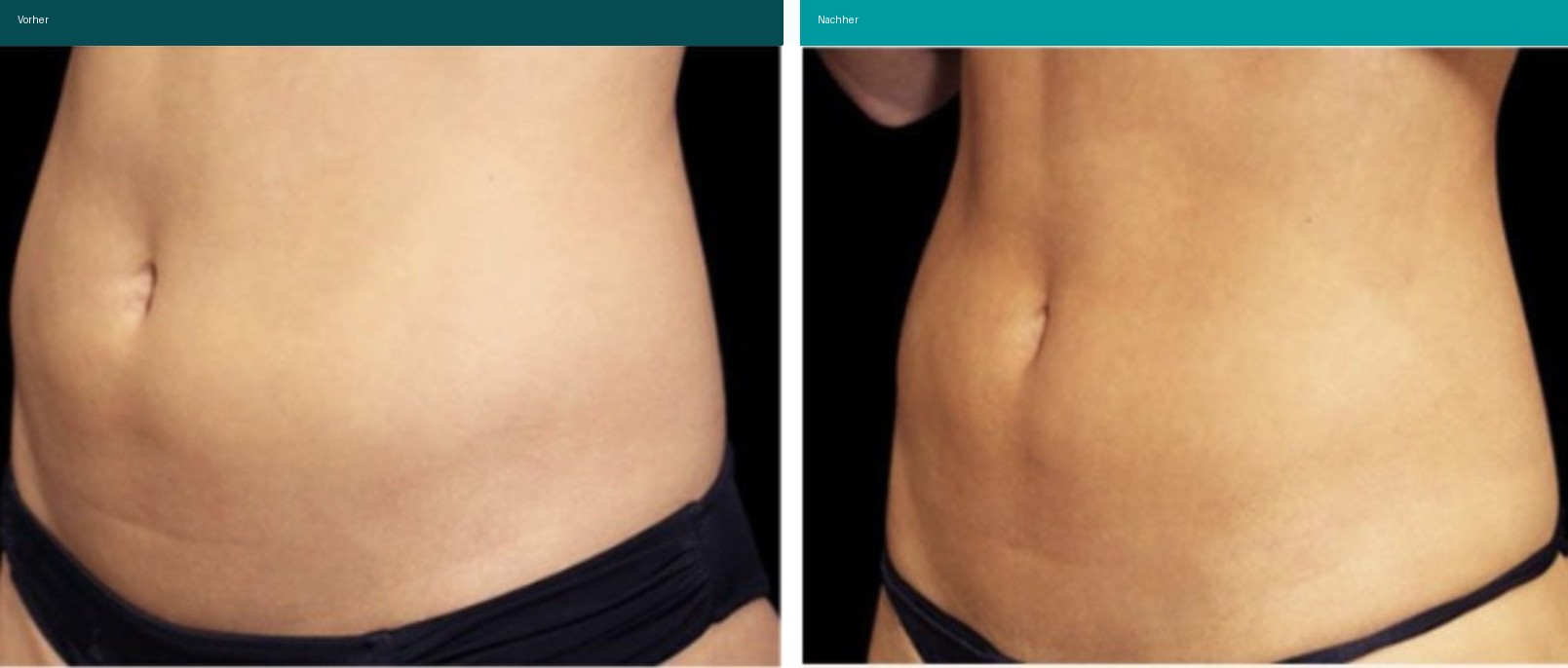 Aesthetische Dermatologie Vorher Nachher Hanau
