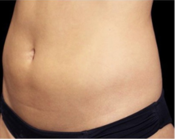 Vorher Aesthetische Dermatologie Hanau