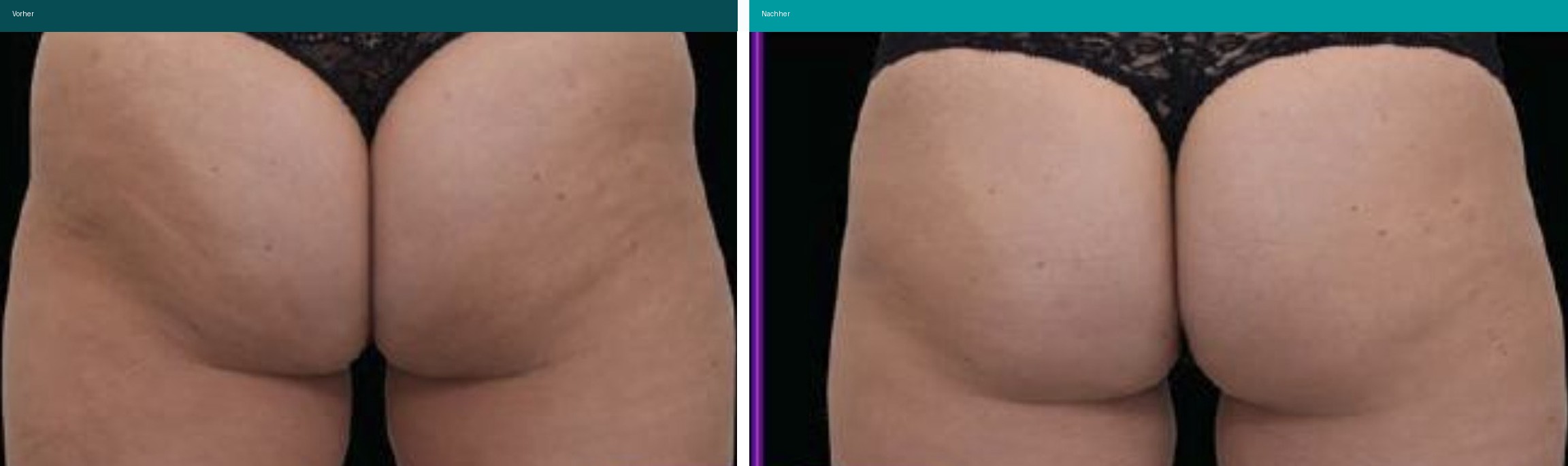 Aesthetische Dermatologie Vorher Nachher Hanau