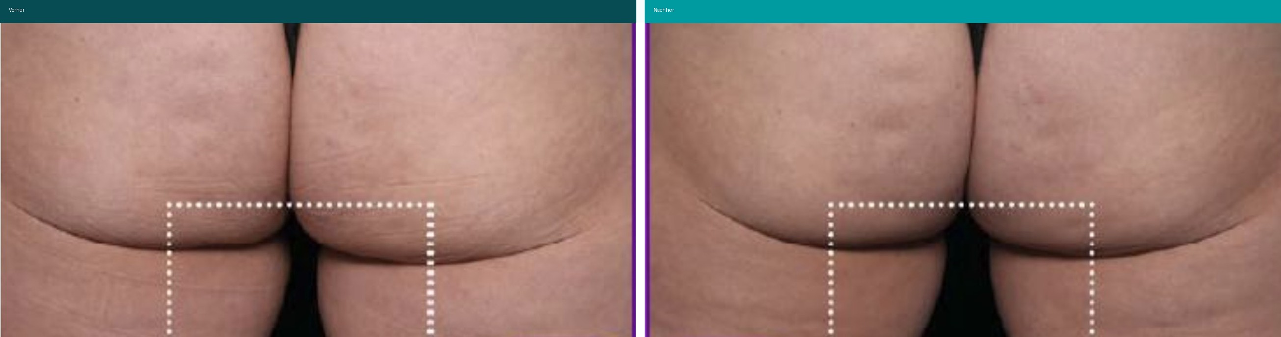 Aesthetische Dermatologie Vorher Nachher Hanau