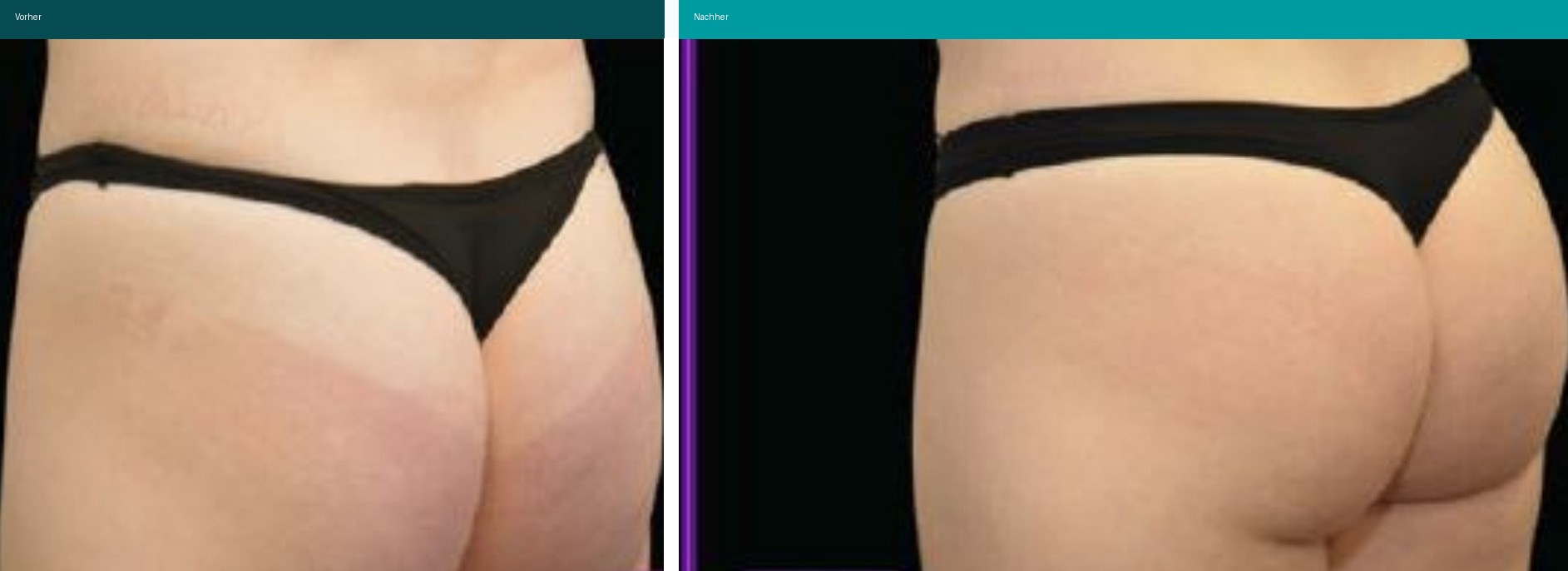 Aesthetische Dermatologie Vorher Nachher Hanau