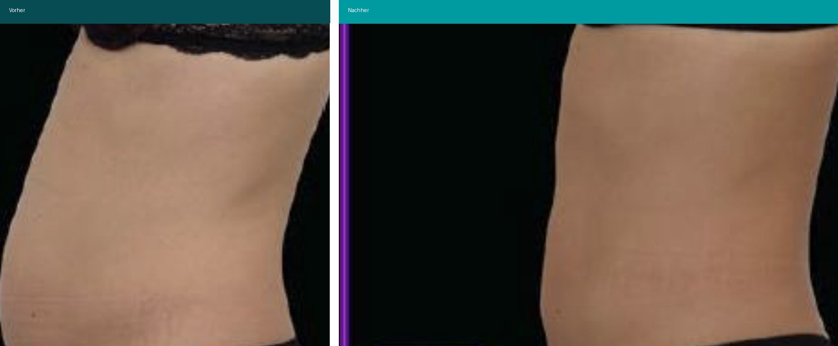 Aesthetische Dermatologie Vorher Nachher Hanau