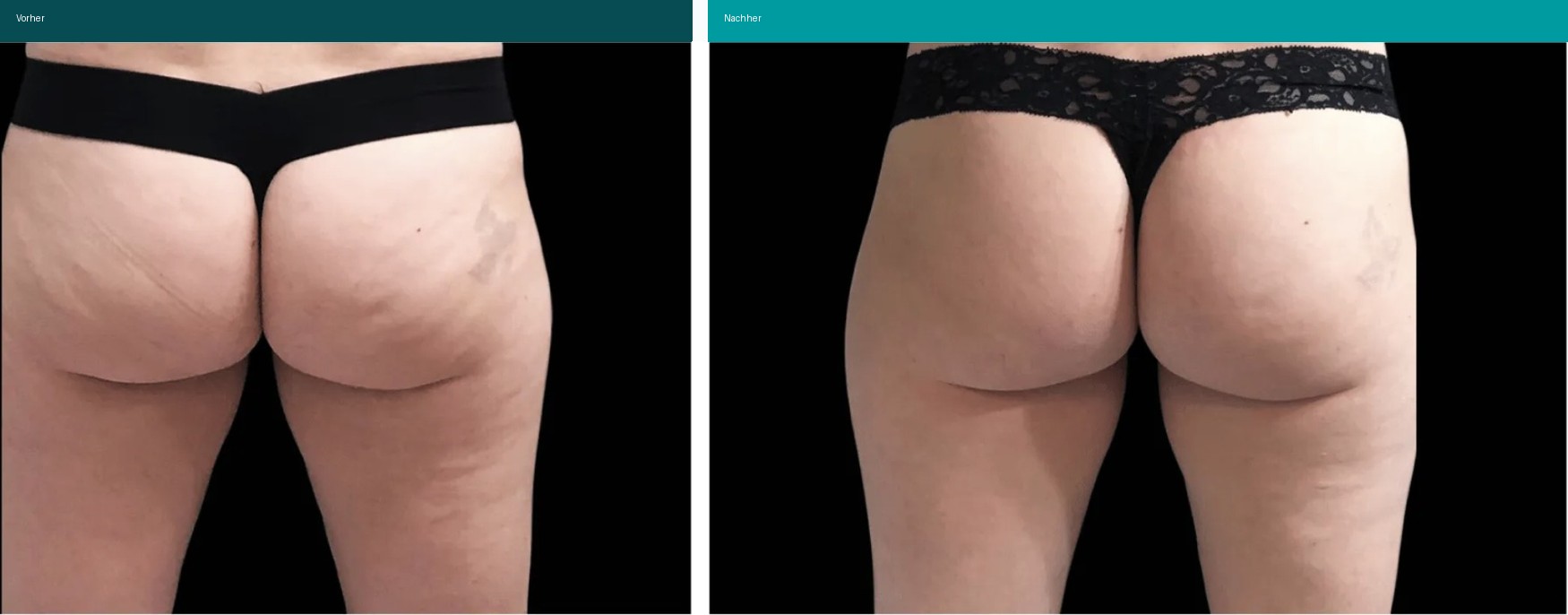 Aesthetische Dermatologie Vorher Nachher Hanau