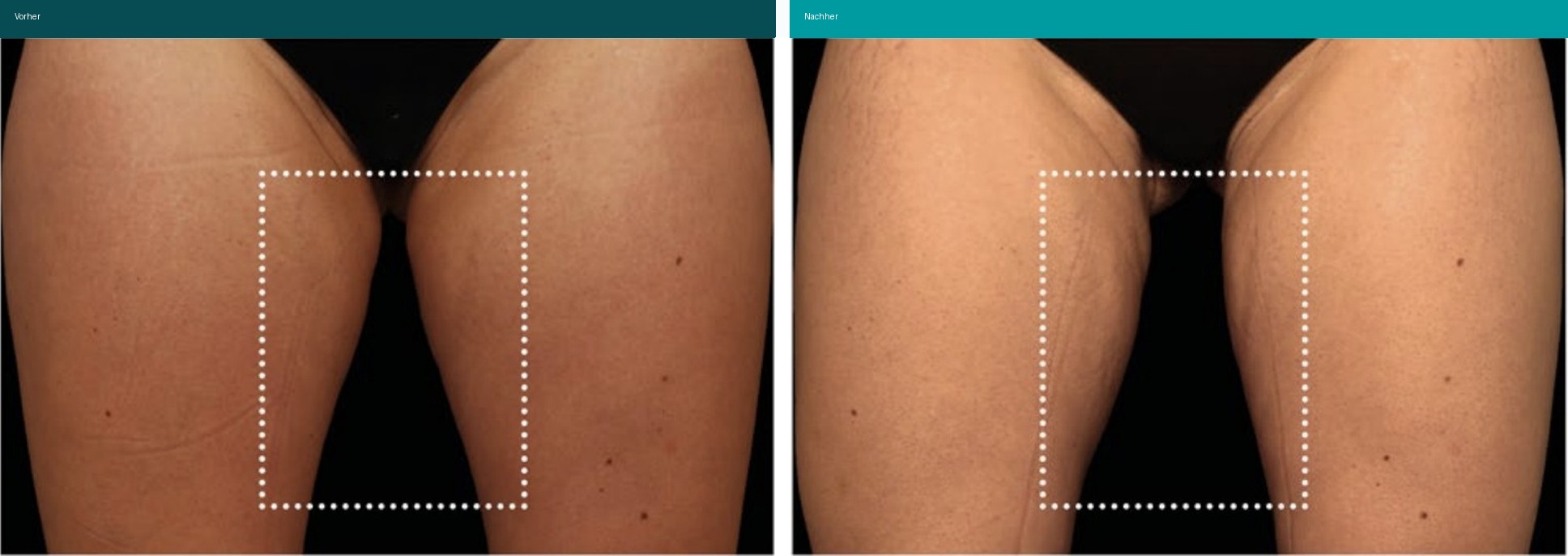 Aesthetische Dermatologie Vorher Nachher Hanau