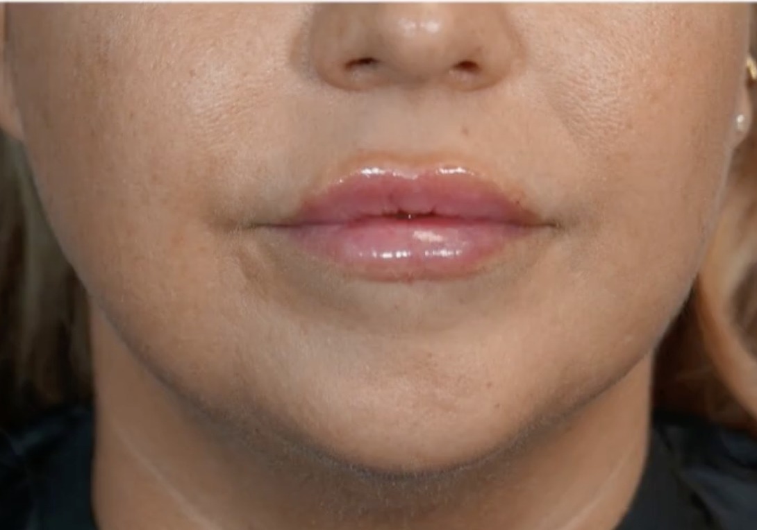 Nachher Aesthetische Dermatologie Hanau