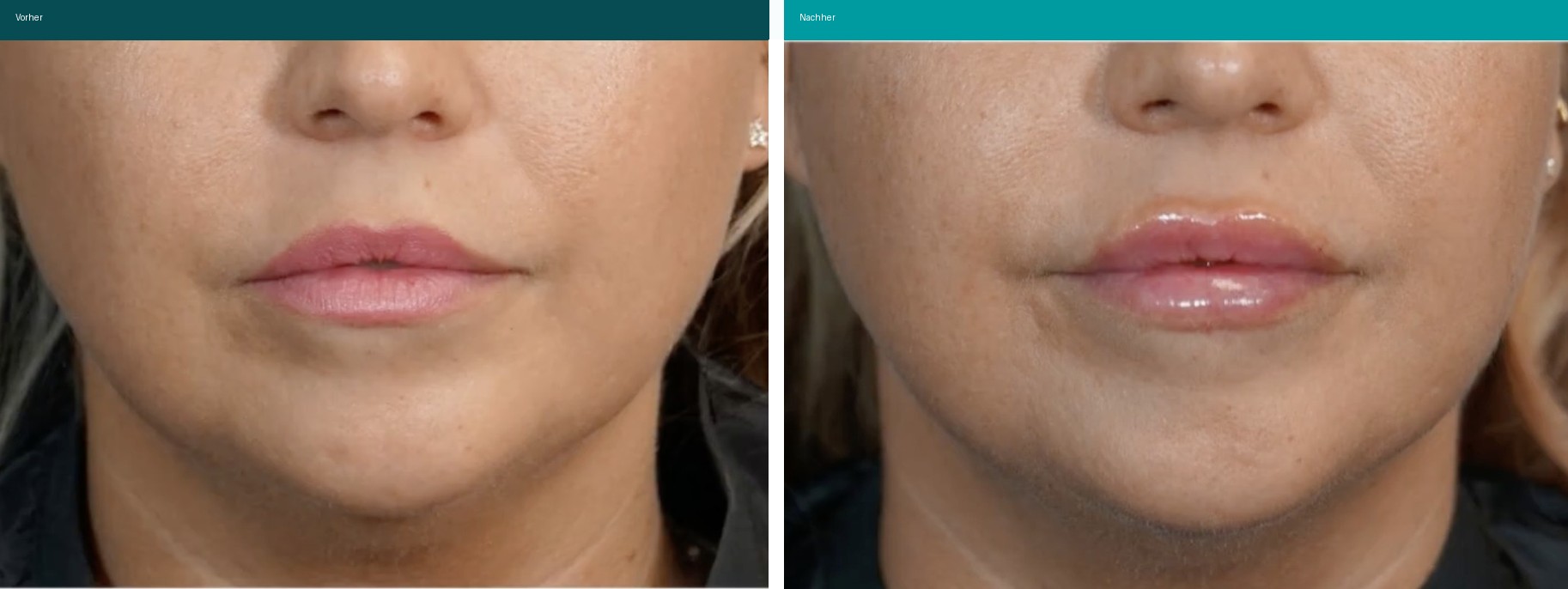Aesthetische Dermatologie Vorher Nachher Hanau