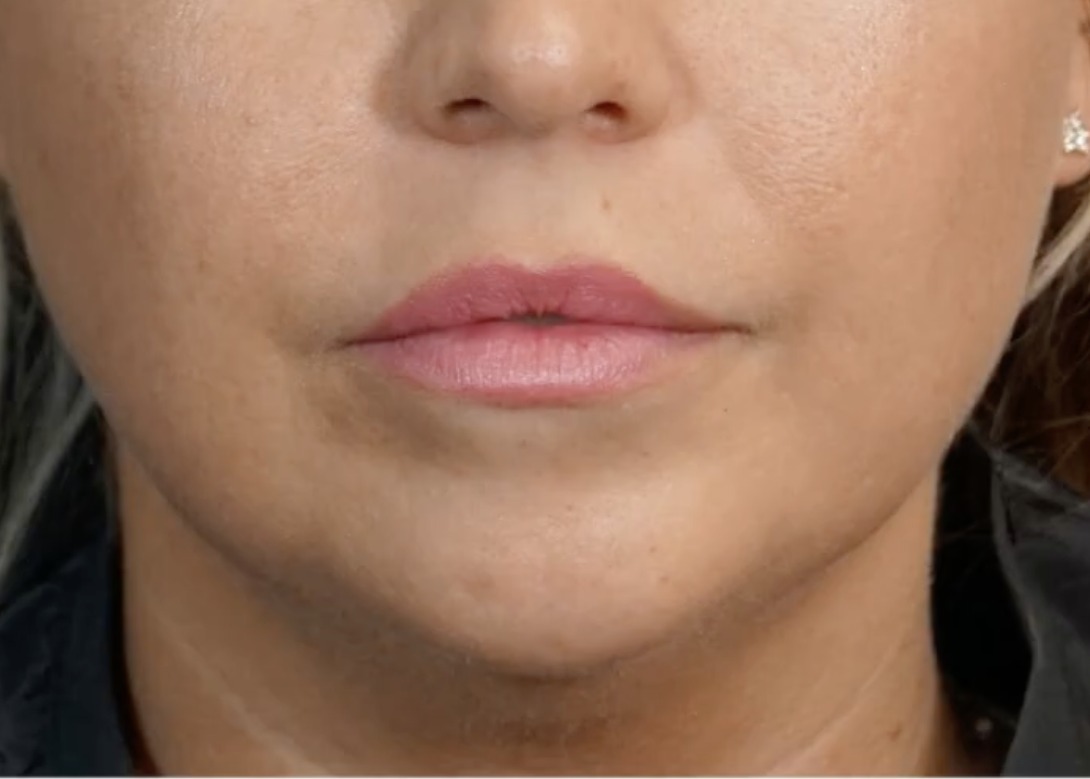 Vorher Aesthetische Dermatologie Hanau