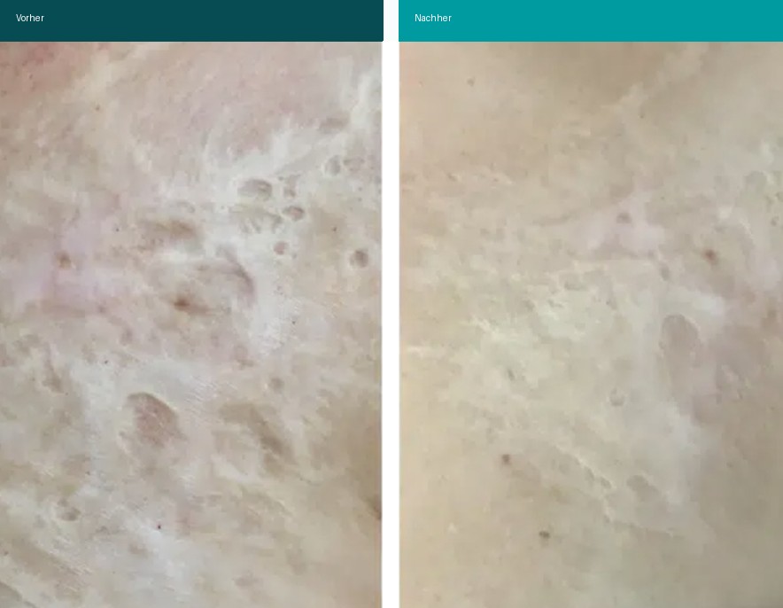 Aesthetische Dermatologie Vorher Nachher Hanau