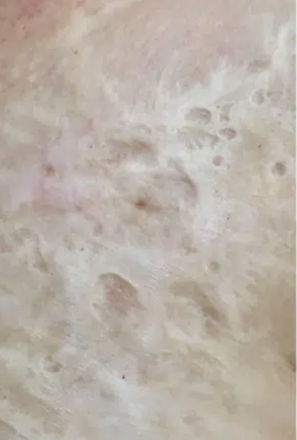 Vorher Aesthetische Dermatologie Hanau