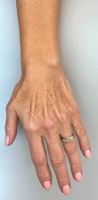 Nachher Handverjuengung in Hanau