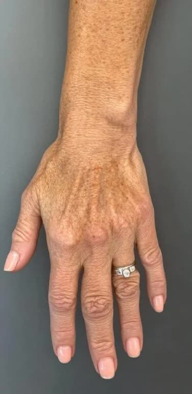 Vorher Handverjuengung in Hanau