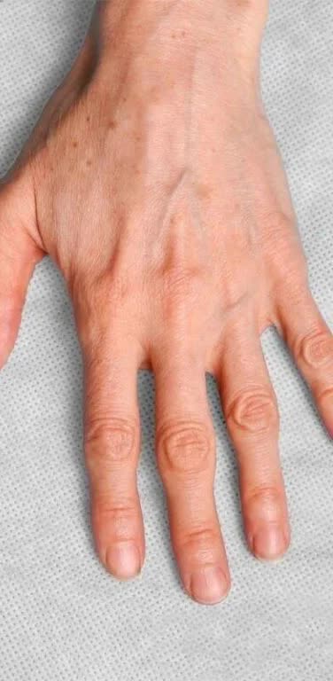 Nachher Handruecken Behandlung Hanau