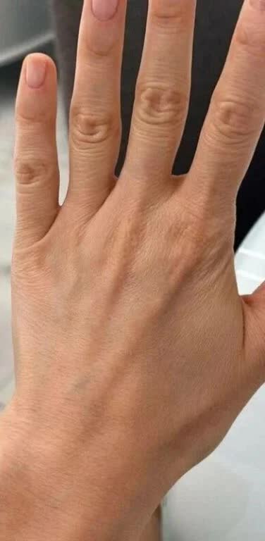 Nachher Hautverjuengung der Hand Hanau