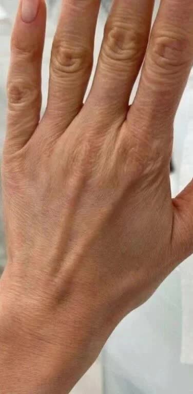 Vorher Hautverjuengung der Hand Hanau