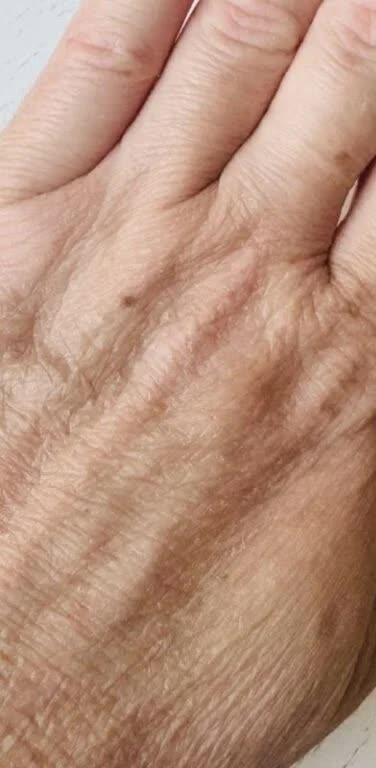 Vorher Altersflecken und Handhaut Hanau