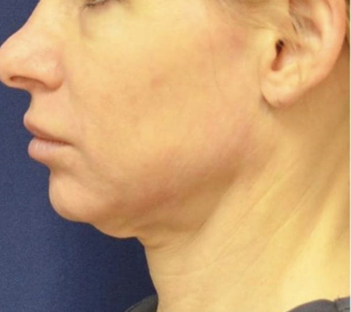 Vorher Hautstraffung Hanau