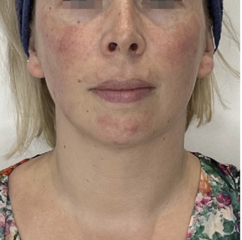 Nach HIFU Lifting im Gesicht frontal