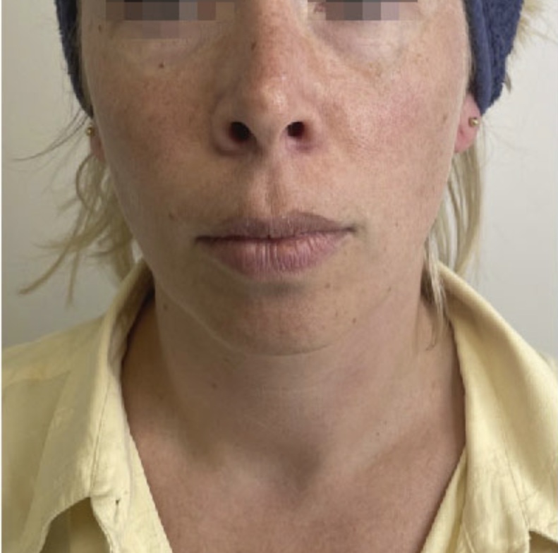 Vor HIFU Lifting im Gesicht frontal