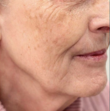 Nach HIFU Lifting seitliche Gesichtskontur