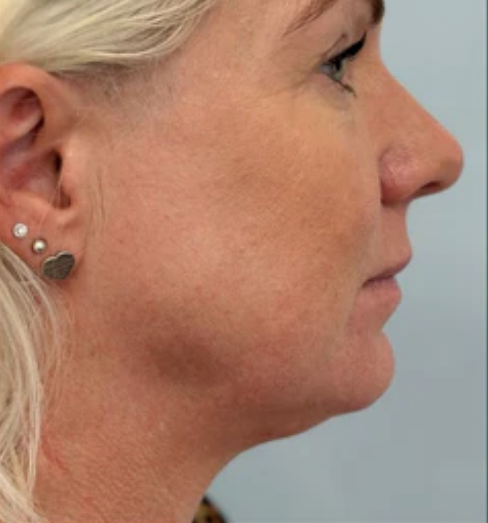 Nach HIFU Lifting Profil und Kinnlinie