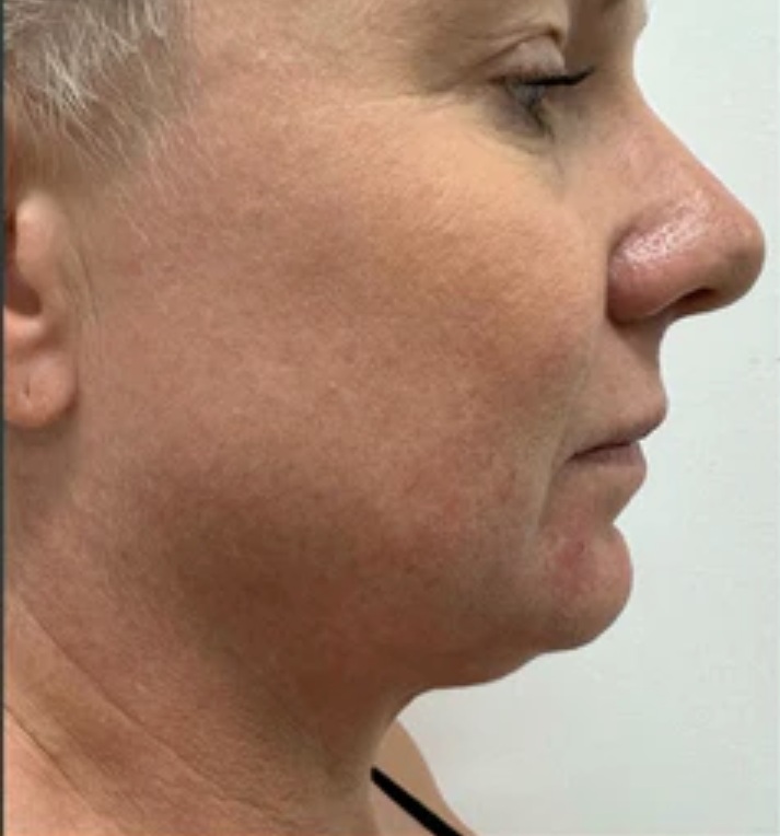 Vor HIFU Lifting Profil und Kinnlinie