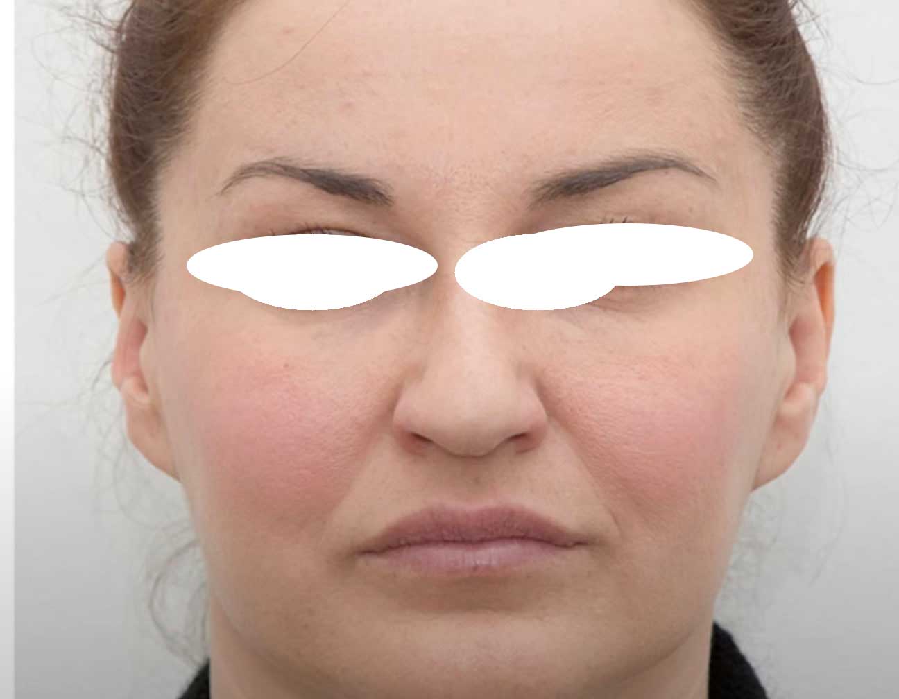 Nachher Hyaluronsaeure Lifting Hanau