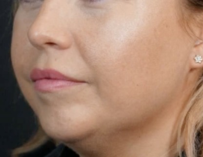 Vorher dezenter Lippenaufbau mit Hyaluronsaeure Hanau