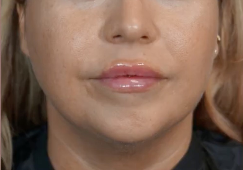 Nachher Lippenunterspritzung mit Hyaluronsaeure Hanau