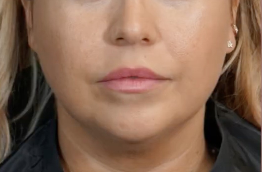 Vorher Lippenunterspritzung mit Hyaluronsaeure Hanau