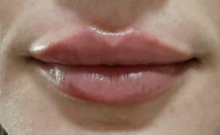 Nachher Lippenaufbau und Kontur mit Hyaluronsaeure Hanau