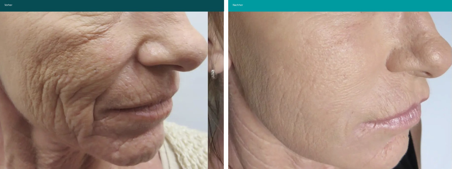 Microneedling PRP Vorher Nachher Hanau