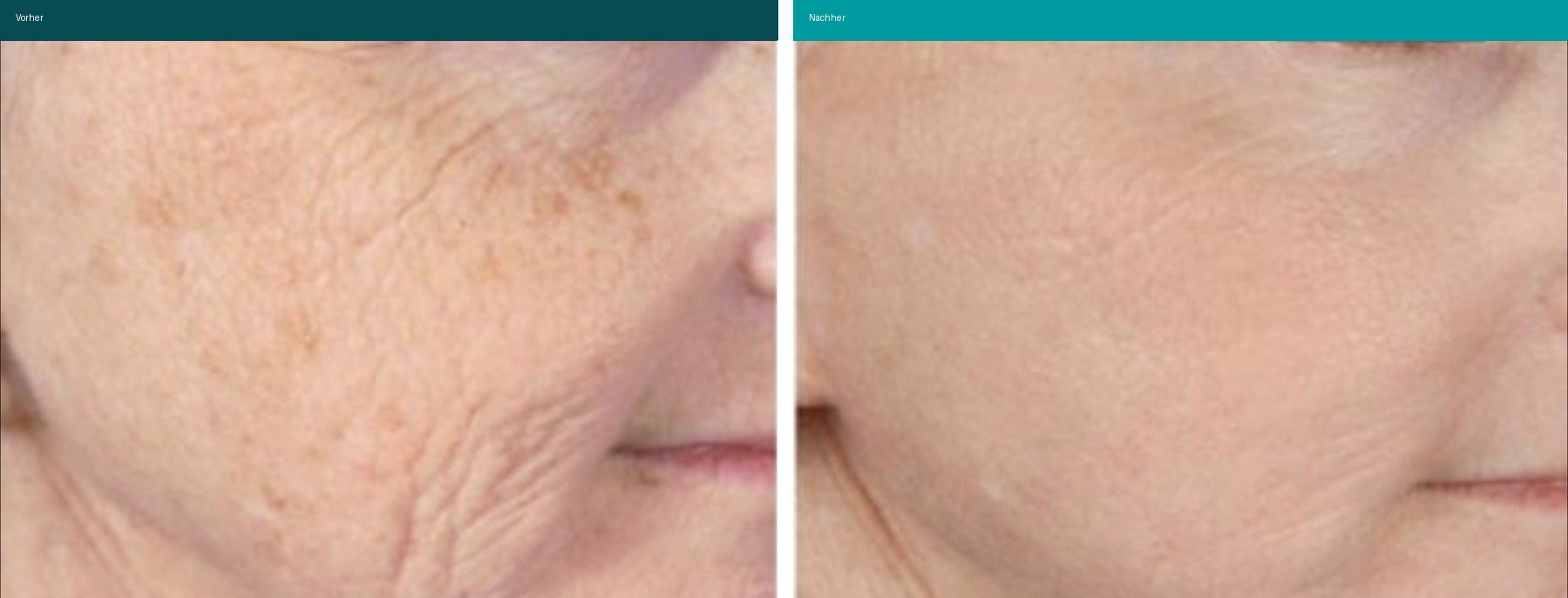 Microneedling PRP Vorher Nachher Hanau