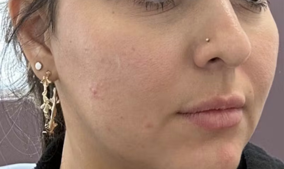 Nachher Vampire Lifting PRP Fall 1 Hanau