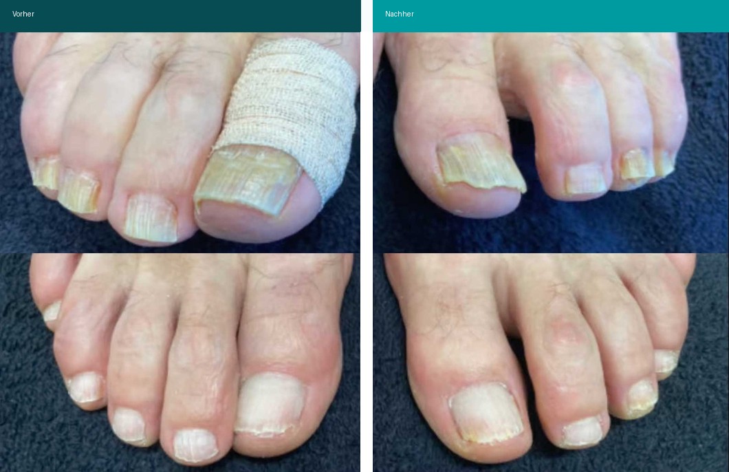 Nagelpilz Vorher Nachher Hanau