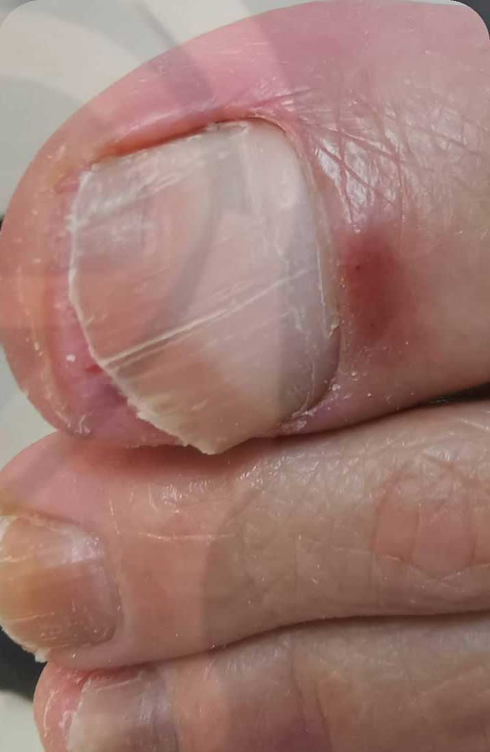 Nachher Nagelpilz am Fussnagel in Hanau